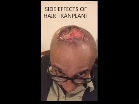 Side Effects of Hair Transplant - YouTube