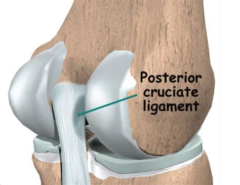 Posterior cruciate ligament injuries - Orthopedic Surgeon For Hip, Knee ...