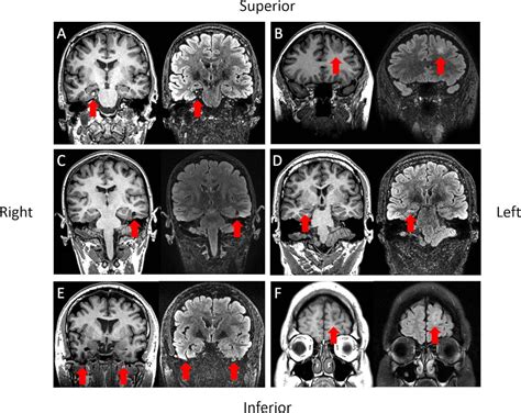 のみご Imaging of Epilepsy A Clinical Atlas裁断済み てんかん