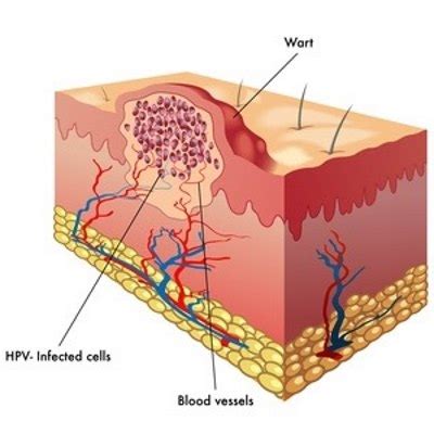 What's are Wart Seeds? | Skin Surgery Laser Clinic