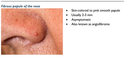 Papules Acne On Nose