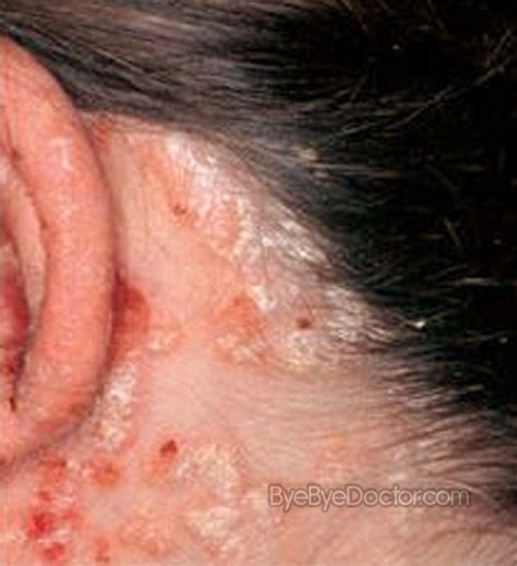 Scalp psoriasis - Pictures, Treatment, Symptoms, Home remedies, Cure