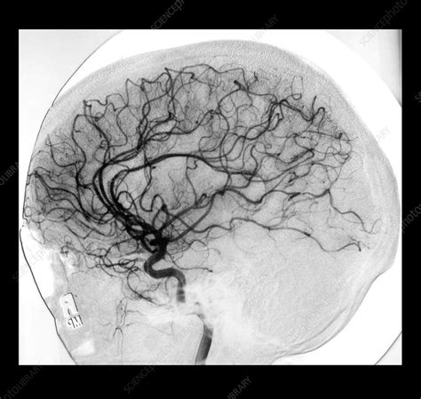 Cerebral Angiogram - Stock Image - F031/9947 - Science Photo Library