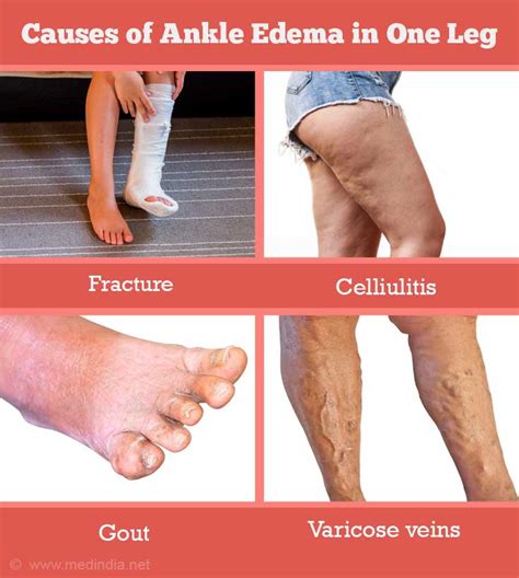 Ankle Edema - Print