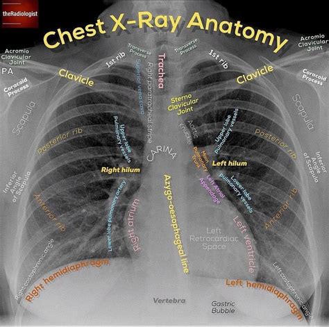 Chest xr | Radiology, Medical radiography, Medical anatomy