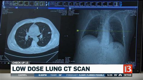 Check Up 13: Low dose lung CT scan | wthr.com