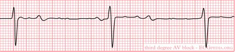 Atrioventricular block EKG examples - wikidoc