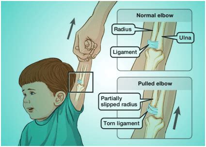 Pulled Elbow: All you need to know - Dr Ratnav Ratan