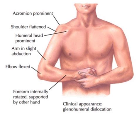 Shoulder Dislocation – Core EM