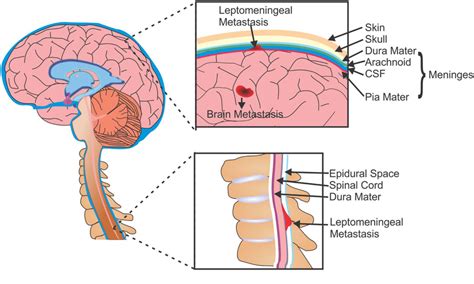 Metastases of the brain and leptomeninges. Cells from primary tumors... | Download Scientific ...