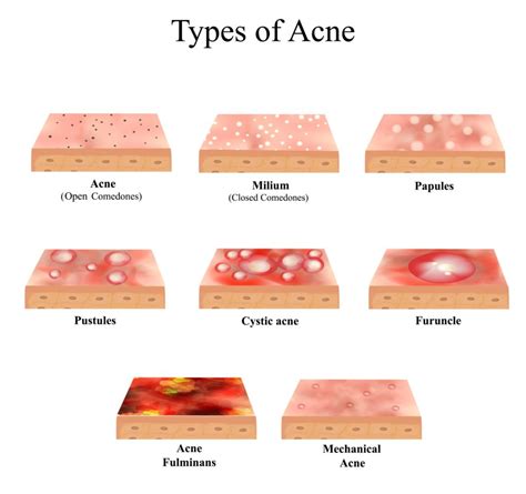 Acne Scar Types