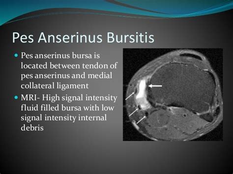 Mri of knee