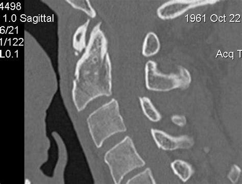 Dens Fracture | The Bone School