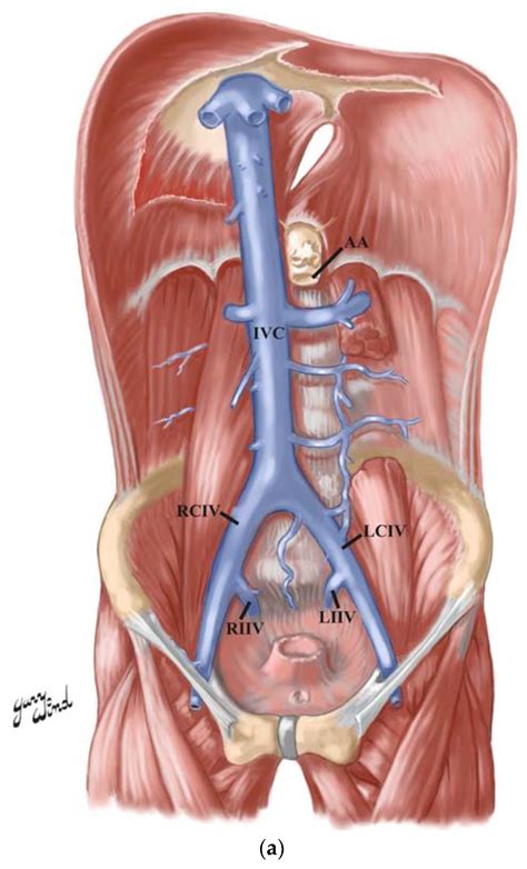 Anatomia | Free Full-Text | Duplicated Inferior Vena Cava in a 69-Year-Old White Female Donor