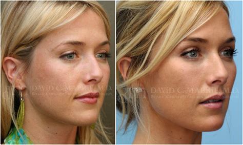 Restylane cheek augmentation & facial reshaping, on the same SF 30y/o patient. | Anti aging skin ...