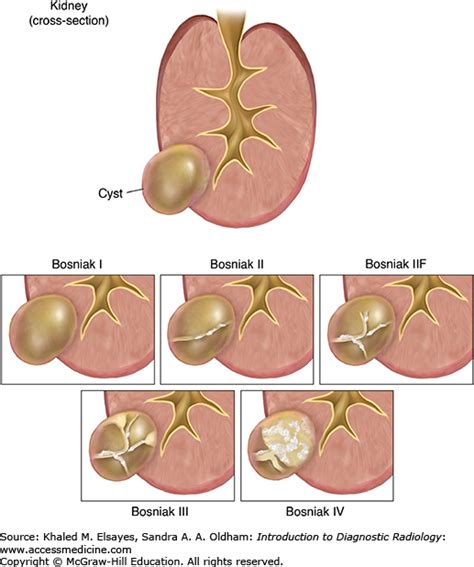 Image result for bosniak | Radiología, Diagnostico por imagenes, Anatomía