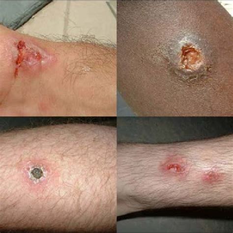 Mucocutaneous leishmaniasis lesion. Photo: source unknown. | Download ...