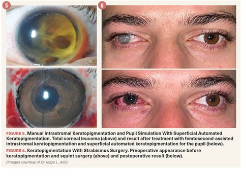 Cosmetic surgery of the cornea: A new type of surgery