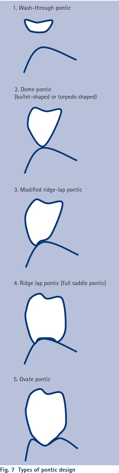 Types of bridge pontics | Dental bridge, Dentistry, Dental ceramics