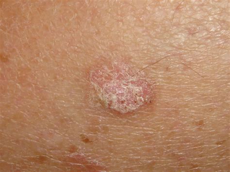 Solar Keratosis: Symptoms, Causes And Complications