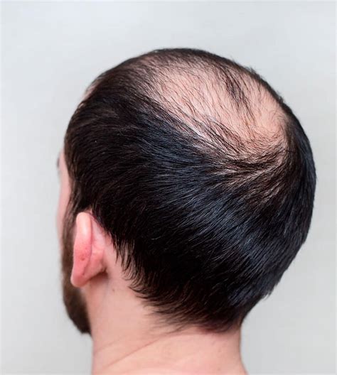 Alopecia Androgénica: Causas, Tratamiento y Solución - Clínica Capilar