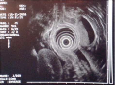 Endoscopic Ultrasound | Abdominal Key