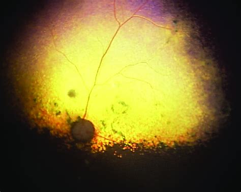 Diffuse retinal degeneration in a dog with inherited progressive... | Download Scientific Diagram