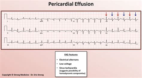 Ecg Pericardial Effusion