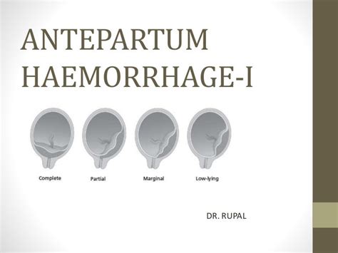 Antepartum haemorrhage i