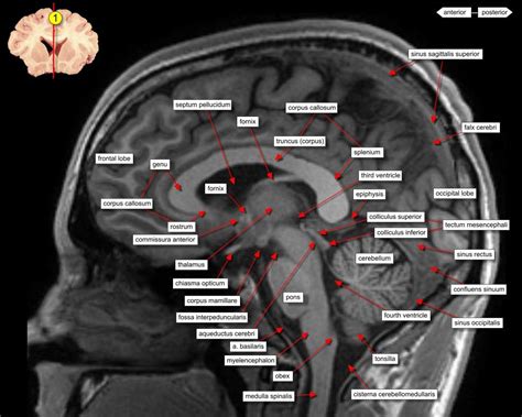 Sagittal Brain Mri Anatomy