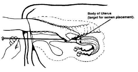 Artificial Insemination