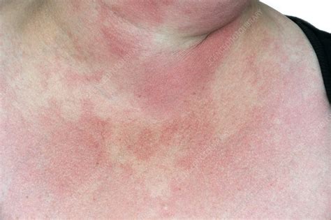 Rash from drug allergy - Stock Image - C010/6671 - Science Photo Library