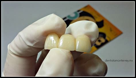 Puente de Porcelana | Dentista, Dental, Clinica dental