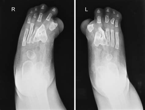 Apert Syndrome: Only 300 cases since 1894! - MEDizzy Journal