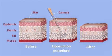 liposuction - Alaxis Medical & Aesthetic Surgery