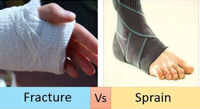 Difference Between Fracture and Sprain (with Comparison Chart) - Bio ...