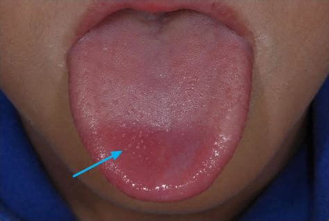 Transient lingual papillitis or lie bumps causes and lie bumps treatment