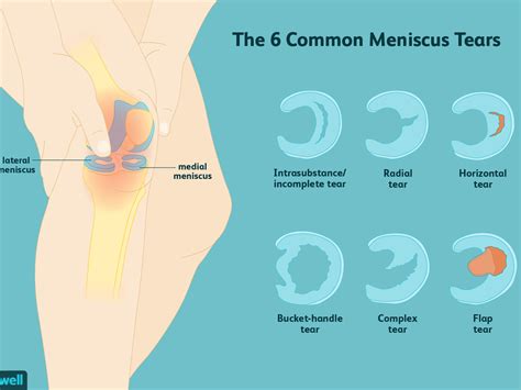 Knee Meniscus Surgeries | Aptiva Health