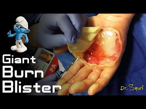 what to do with burn blister