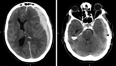 Kernohan's notch and misdiagnosis of disorders of consciousness -- Simonin et al. 2014 -- BMJ ...