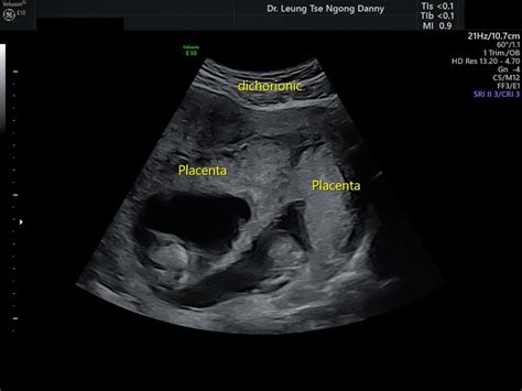 Twins - Classification and diagnosis - HKOG-INFO