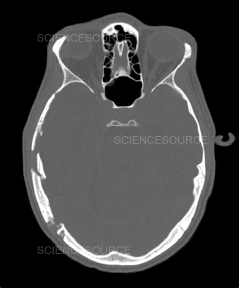 Photograph | CT of Skull Fracture | Science Source Images