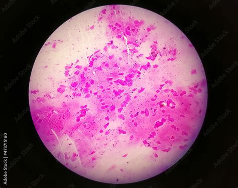 High Vaginal Swab (HVS) gram stain microscopic 10x show few pus cells ...