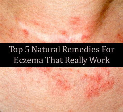 Top 5 Natural Remedies For Eczema That Really Work