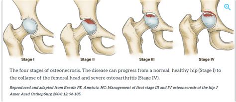 Avascular necrosis treatment of hip at AIOR: Avascular necrosis of the ...