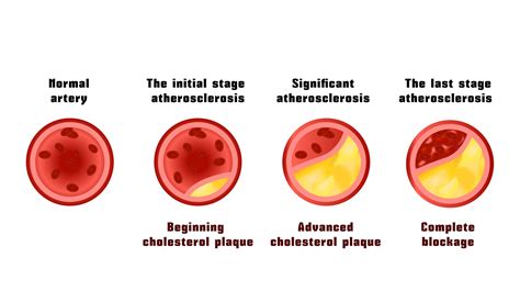 Dissolve Plaque In Blood Vessels at Paul Cornell blog