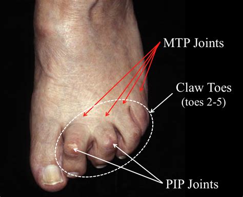 Extensor Tendon Lengthening for Clawtoe Correction - FootEducation