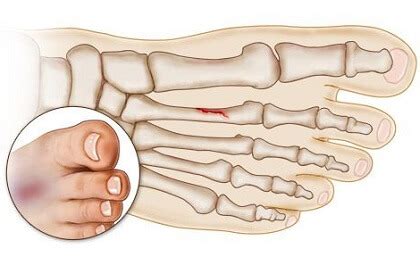 Stress Fracture Foot Problems: Causes & Treatment