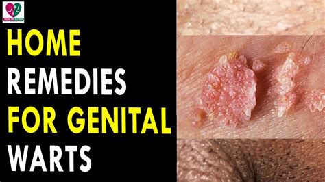 Inspiration 45 of Genital Warts Home Treatment | quigleymanot