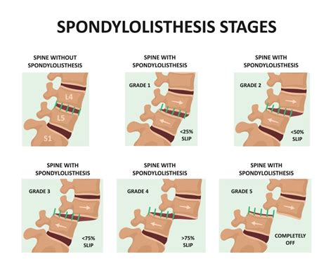 Spondylolisthesis: Another Good Reason To Take Better Care Of Your Back | KERA News